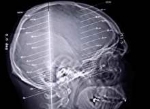 Epilepsi Ameliyatı Epilepsi Ameliyatı