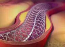 Karotis Anjiyoplasti Karotis Anjiyoplasti