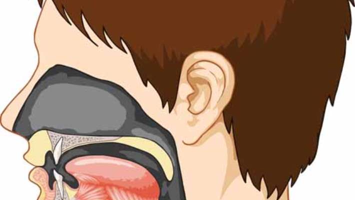 Akut Solunum Sendromu