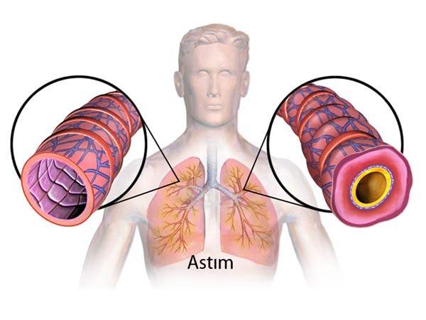 Astım Türleri