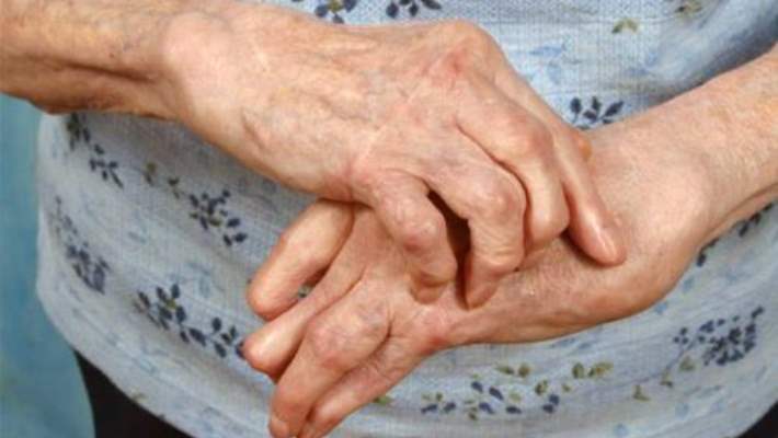 Artrit Ve De Quervain Hastalığı