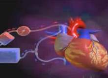 Kalp Hastalıkları ve Kalp Baypas Ameliyatı Kalp Hastalıkları ve Kalp Baypas Ameliyatı