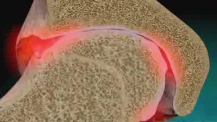 Diz Yaralanmaları Ve Osteoartrit