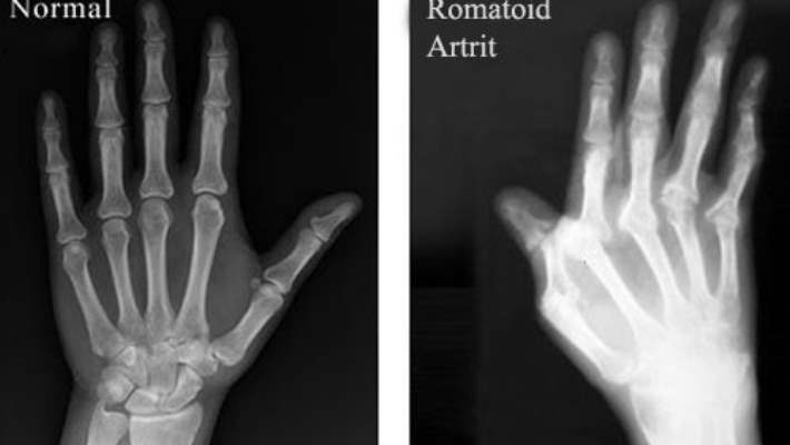 El Ve Parmaklarda Romatoid Artrit