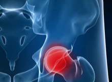 Kalça Romatoid Artriti Kalça Romatoid Artriti