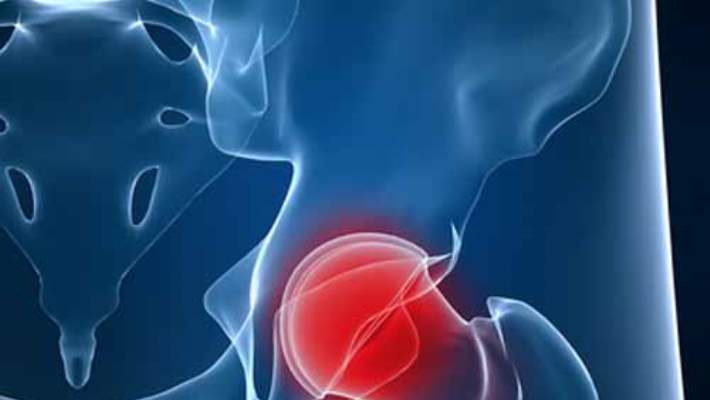 Kalça Romatoid Artriti