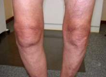 Diz Romatoid Artriti Diz Romatoid Artriti