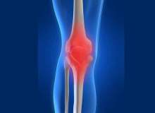 Romatoid Artritin Nedenleri Romatoid Artritin Nedenleri