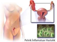 Kronik Pelvik Ağrı ve Vulva Ağrısı Tedavileri Kronik Pelvik Ağrı ve Vulva Ağrısı Tedavileri