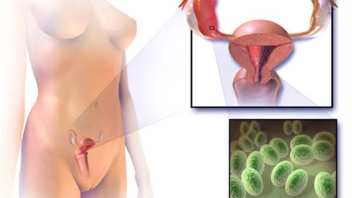 Kronik Pelvik Ağrı Ve Vulva Ağrısı Tedavileri
