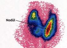 Tiroid Nodülleri Tiroid Nodülleri