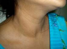 Guatrınız Olup Da Tiroid Problemleriniz Olmayabilir mi? Guatrınız Olup Da Tiroid Problemleriniz Olmayabilir mi?