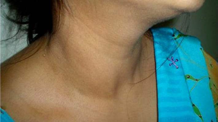 Guatrınız Olup Da Tiroid Problemleriniz Olmayabilir Mi?