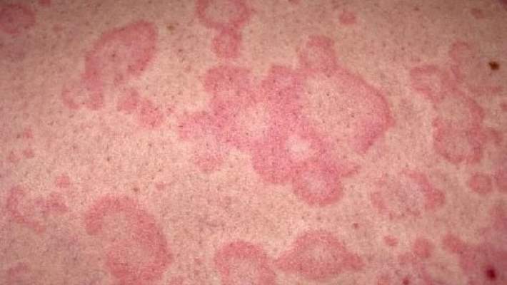 Zehirli Sarmaşık Döküntüsünden Nasıl Kurtulabilirsiniz