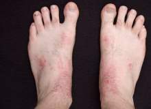 Atopik Dermatit