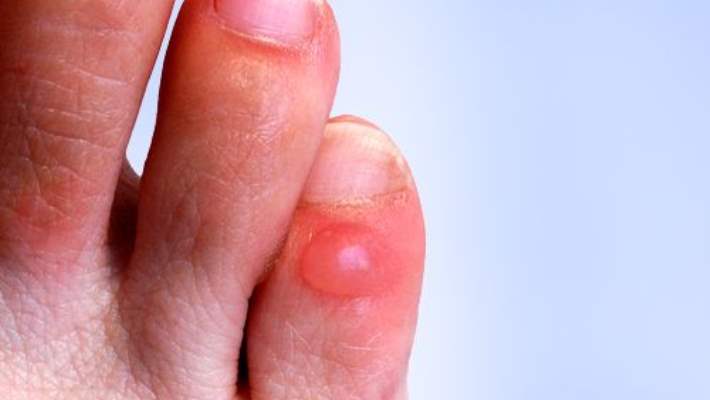 Su Toplamalarını Anlama - Tedavi