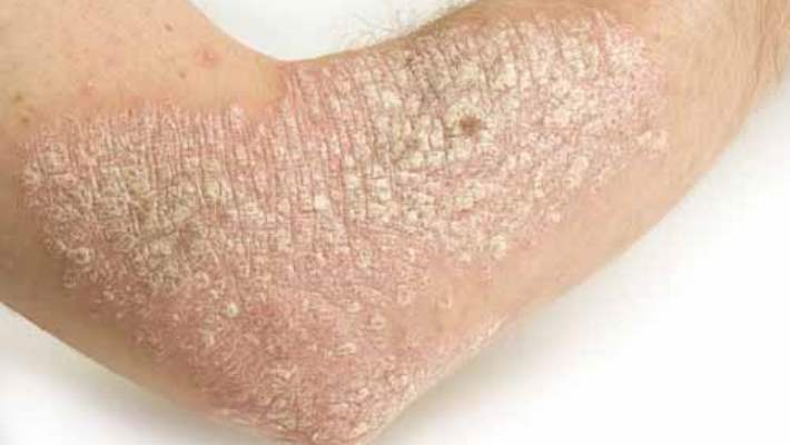 Sedefe Bağlı Eklem İltihabında Halsizlikle Mücadele İçin 10 İpucu