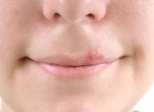 Uçuklardan Kurtulmak Uçuklardan Kurtulmak