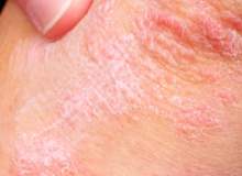 Sedefe Bağlı Eklem İltihabında Stresi Yenebilmek İçin İpuçları Sedefe Bağlı Eklem İltihabında Stresi Yenebilmek İçin İpuçları