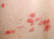 Hamilelik Sırasında Zona Hamilelik Sırasında Zona