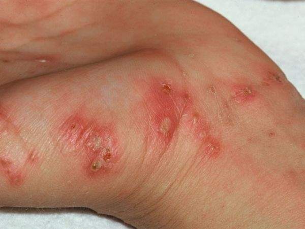 Hidradenitis Süpürativa