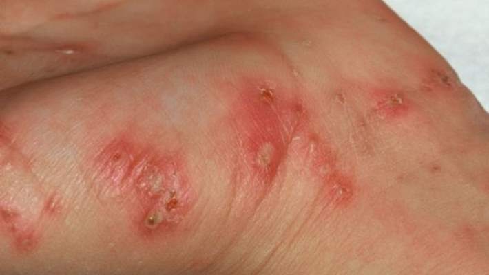 Hidradenitis Süpürativa