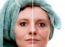 Yetişkinlerde Akne: Neden Meydana Gelir, Nasıl Mücadele Edilir? Yetişkinlerde Akne: Neden Meydana Gelir, Nasıl Mücadele Edilir?