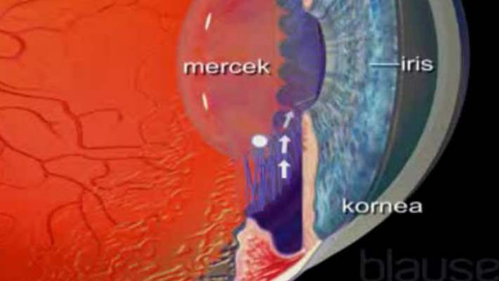 İris İltihabı (İritis)