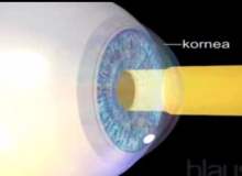 Kornea Ülseri Kornea Ülseri