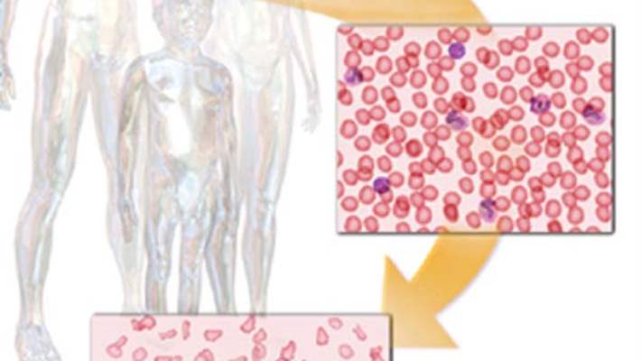 Talasemi (Akdeniz Anemisi)