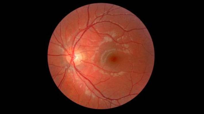 Yaşa Bağlı Sarı Nokta Hastalığıyla (Amd) Yaşamak