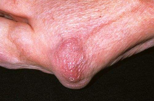 Bursit (İskiogluteal)