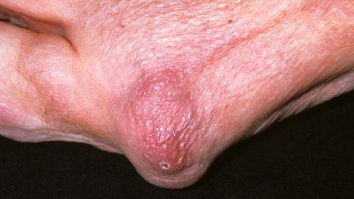 Bursit (İskiogluteal)