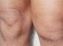 Prepatellar Bursit Prepatellar Bursit