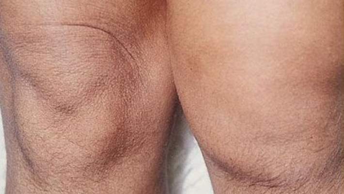 Prepatellar Bursit