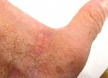 Kayakçı Başparmağı Kayakçı Başparmağı