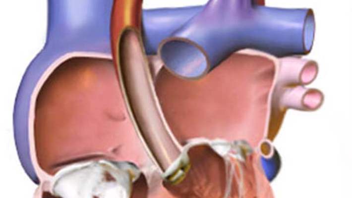 Doğumsal (Konjenital) Kalp Hastalıkları