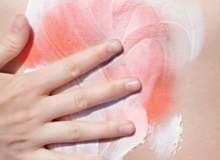 Güneş Yanığı Güneş Yanığı