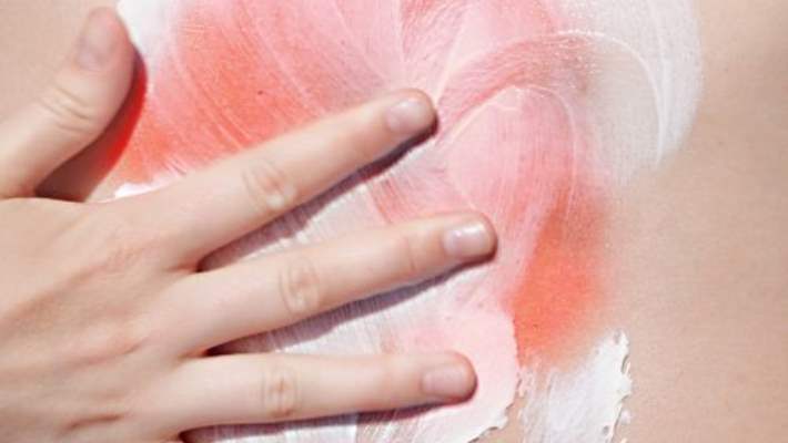 gunes yanigi hemen saglik