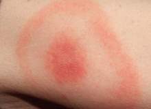 Eritema Migran Eritema Migran