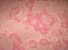 Eritema Nodosum Eritema Nodosum