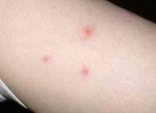 Çıbanlar Çıbanlar