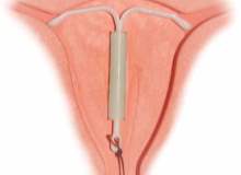 Hormonlu Spiral (Mirena) Hormonlu Spiral (Mirena)