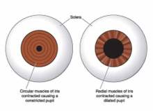 Akut Açı Kapanması Glokomu Akut Açı Kapanması Glokomu
