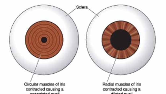 Akut Açı Kapanması Glokomu