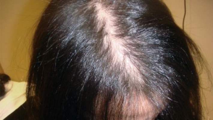 Saç Ekimi Ameliyatı: Saç Dökülmesine Kalıcı Çözüm