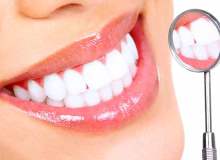 Diş Beyazlatma: Nasıl Yapılır