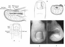 Tırnak Batması Tırnak Batması