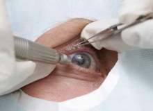 Kozmetik Göz Ameliyatı Kozmetik Göz Ameliyatı