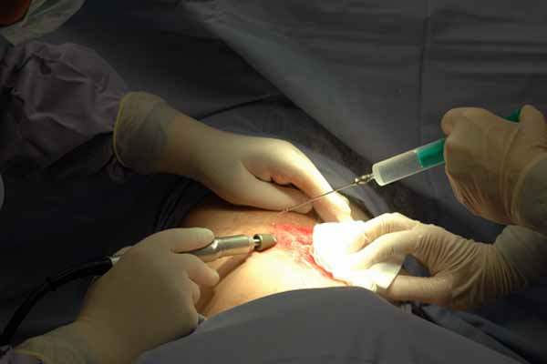 Mikrodermabrazyon ve Genel Kullanımları